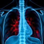 Can Mesothelioma Be Prevented? Expert Opinions and Safety Tips