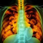 Is Mesothelioma Always Caused by Asbestos?